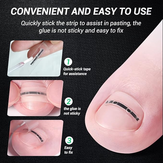 Titanium Alloy Ingrown Toenail Treatment, Nail Tools, and Ingrown Toenail Removal Kit Specially Designed for Curved Nail Repair and Ingrown Toenail Corrector (0.67/0.79in)